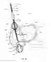 Fig. 07 - Cardiac Access Catheter, System, and Method
