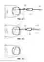 Fig. 03 - Method of treating infections, diseases or disorders of nail unit