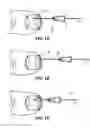 Fig. 04 - Method of treating infections, diseases or disorders of nail unit