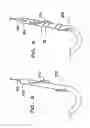 Fig. 09 - Device for preparing an implanted medical apparatus for extraction