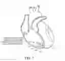 Fig. 02 - Automatic capture verification within leadless implantable medical devices