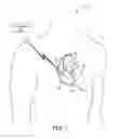 Fig. 02 - Method and apparatus for detecting loss of capture