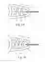 Fig. 03 - Self Gripping Clip Apparatus