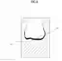 Fig. 04 - Method for producing temporary prosthesis