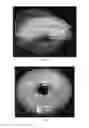 Fig. 08 - TISSUE EXPANDER