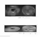 Fig. 09 - TISSUE EXPANDER