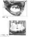Fig. 06 - Extracellular matrix material valve conduit and methods of making thereof