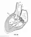 Fig. 09 - Everting Heart Valve
