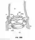 Fig. 49 - Everting Heart Valve