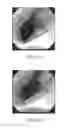 Fig. 35 - CARTRIDGE AND METHOD FOR INCREASING MYOCARDIAL FUNCTION