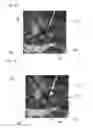 Fig. 08 - MEDICAL SYSTEM AND METHOD FOR PLANNING AND/OR TUNING A NEUROMODULATION THERAPY