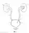 Fig. 02 - Nephroureterectomy apparatus