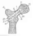 Fig. 01 - Method for fixation of bone fragments at bone fractures