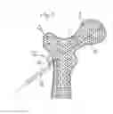 Fig. 02 - Method for fixation of bone fragments at bone fractures