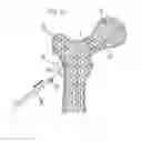Fig. 03 - Method for fixation of bone fragments at bone fractures