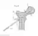 Fig. 04 - Method for fixation of bone fragments at bone fractures