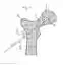 Fig. 05 - Method for fixation of bone fragments at bone fractures
