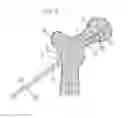 Fig. 06 - Method for fixation of bone fragments at bone fractures