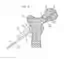 Fig. 07 - Method for fixation of bone fragments at bone fractures
