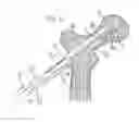 Fig. 09 - Method for fixation of bone fragments at bone fractures