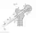 Fig. 10 - Method for fixation of bone fragments at bone fractures