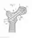 Fig. 12 - Method for fixation of bone fragments at bone fractures