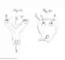 Fig. 14 - Method for fixation of bone fragments at bone fractures