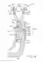 Fig. 13 - Prosthetic inserter