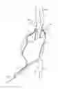 Fig. 01 - Method and system for treating aneurysms