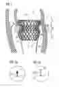 Fig. 02 - Transcatheter valve prosthesis