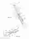 Fig. 02 - Extravascular implant for facilitating sutured side-to-side arteriovenous fistula creation and maintaining patency