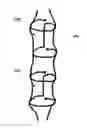 Fig. 01 - INDWELLING BODY LUMEN EXPANDER