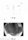 Fig. 03 - INDWELLING BODY LUMEN EXPANDER