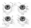 Fig. 05 - Methods, systems and devices for treating glaucoma