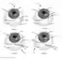 Fig. 07 - Methods, systems and devices for treating glaucoma