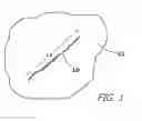 Fig. 02 - System and Method for Protecting a Wound on the Skin