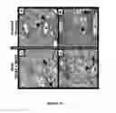 Fig. 32 - COMPOSITIONS AND METHODS FOR PREVENTING OR TREATING CHRONIC LUNG ALLOGRAFT DYSFUNCTION (CLAD) AND IDIOPATHIC PULMONARY FIBROSIS (IPF)