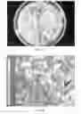 Fig. 03 - COMPOSITION AND METHOD OF PREPARATION OF BONE ALLOGRAFT FROM ENDOSTEAL PORTION OF BONE AND ISOLATED BONE PERIOSTEUM