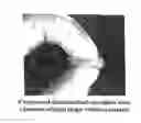 Fig. 01 - Demineralized Bone Matrix