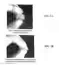 Fig. 02 - Demineralized Bone Matrix