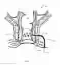 Fig. 02 - TECHNIQUES FOR TREATMENT OF ABSCESSES