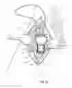 Fig. 09 - Vascular access port systems and methods