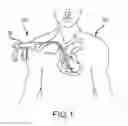 Fig. 02 - Medical device for removing an implanted object