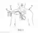 Fig. 02 - Medical device for removing an implanted object