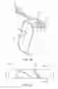 Fig. 06 - Medical device for removing an implanted object