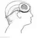 Fig. 01 - Method for the treatment of ischemic stroke by applying an electromagnetic field