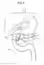 Fig. 07 - METHOD FOR COLLECTING DUODENAL JUICE
