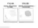 Fig. 08 - METHOD FOR COLLECTING DUODENAL JUICE