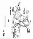 Fig. 04 - Method for dynamic regulations (counter pulsation) of the venous return to the heart for the treatment of patients with heart failure