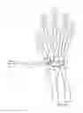 Fig. 09 - Percutaneous exchange tube and method of use
